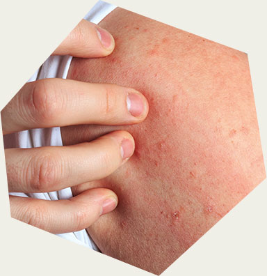 Short-term Damaged Skin
