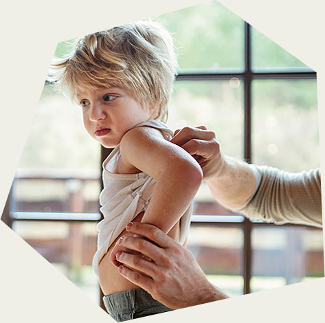 Eczema