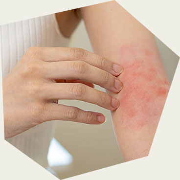 Irritated Skin