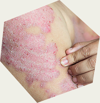 Psoriasis